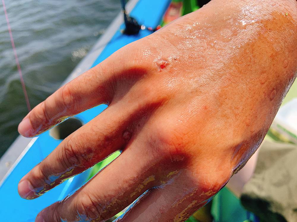 蛸に噛まれた跡 Oretsuri 俺釣